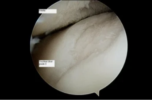 view on astroscope with osteoarthritis of the knee joint 3. degrees