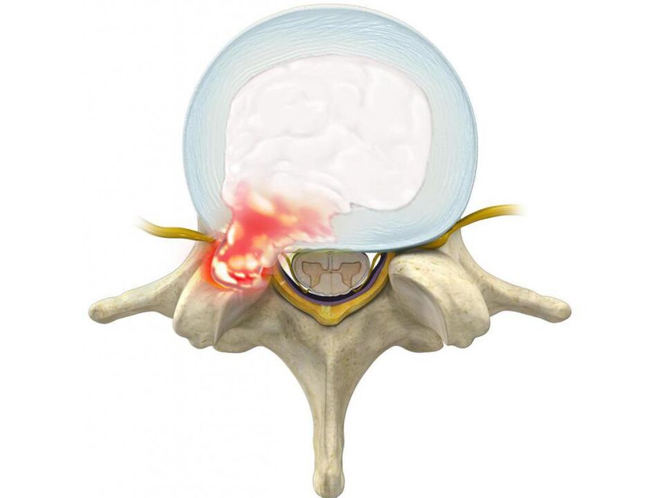 damaged disc leads to back pain