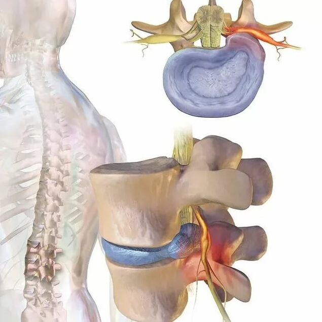 intervertebral disc problems