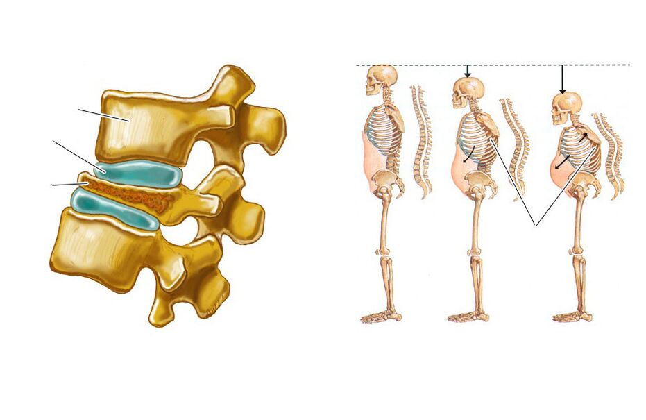 sagging spine leads to back pain