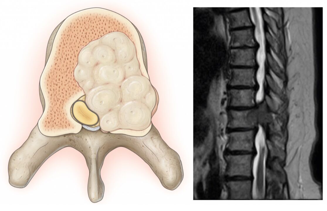 swelling of the spine leads to back pain