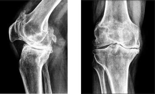 Gonarthrosis of the knee on X-ray