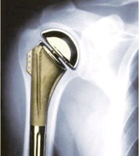 shoulder prosthesis for osteoarthritis