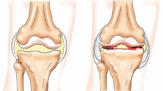 Chondromatose