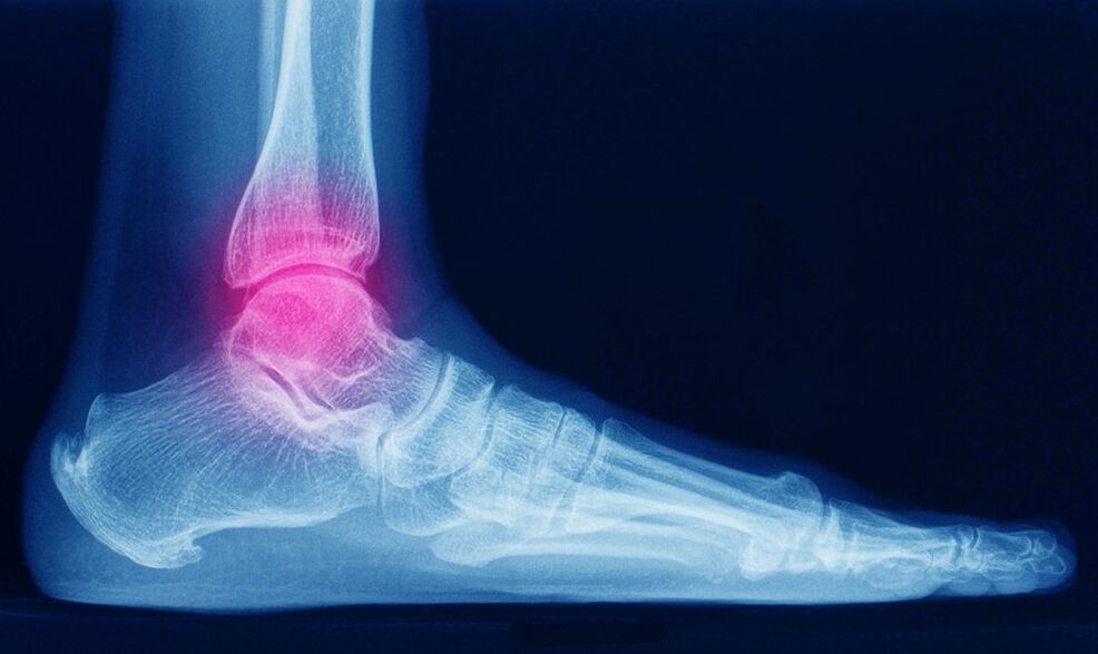 symptoms of arthrosis of the ankle