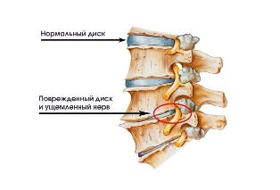 Cervical symptoms of degenerative disc disease