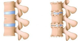 how to recognize the presence of osteochondrosis of the lumbar spine