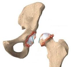 causes of osteoarthritis of the hip