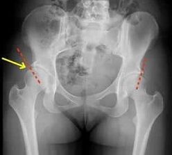 methods of treating osteoarthritis of the hip