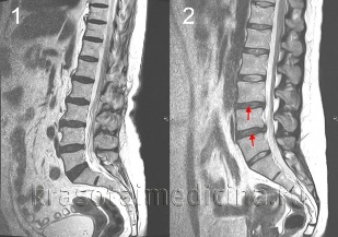 back pain spine